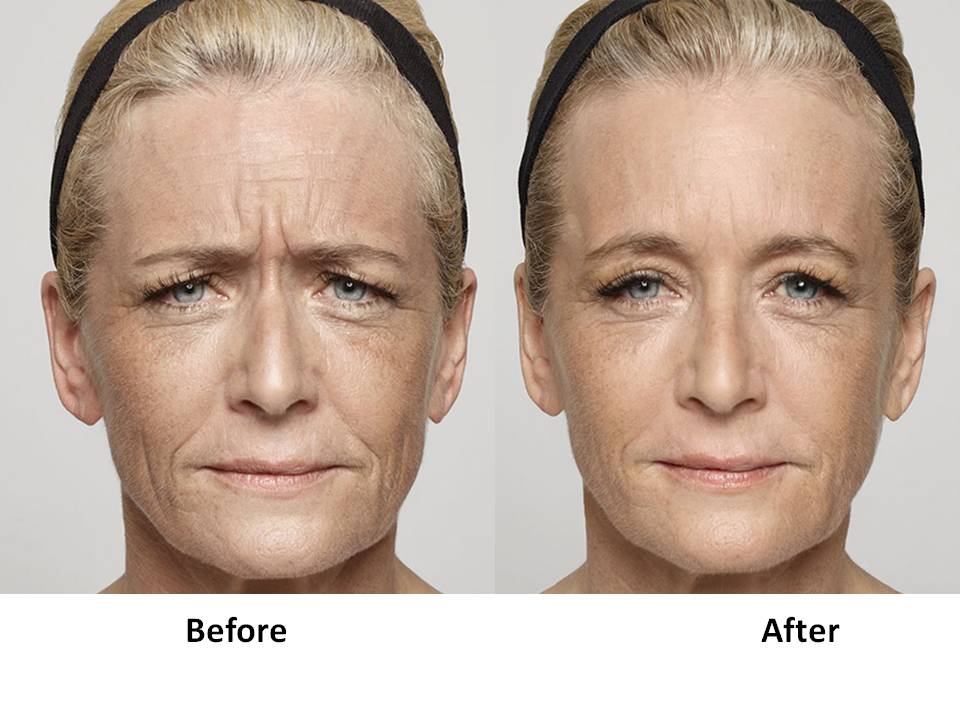 before after rejuvenate medspa